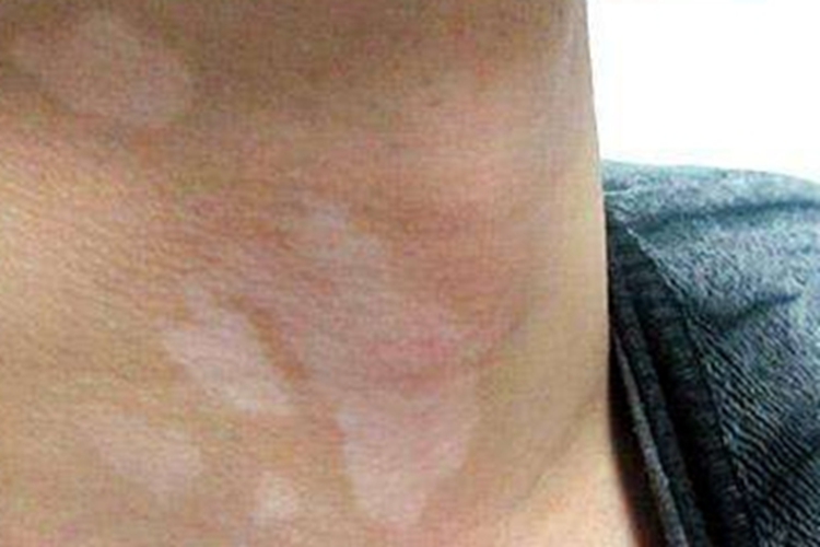 非节段型白癜风颈部白斑图