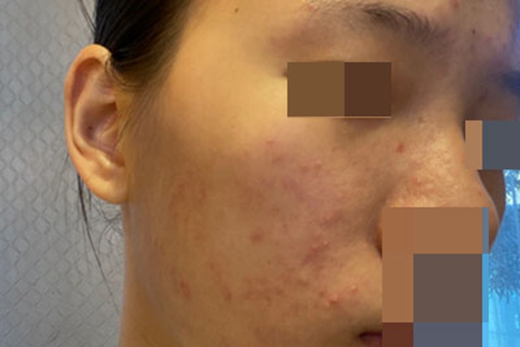 痤疮脸上有好多红色小疙瘩图