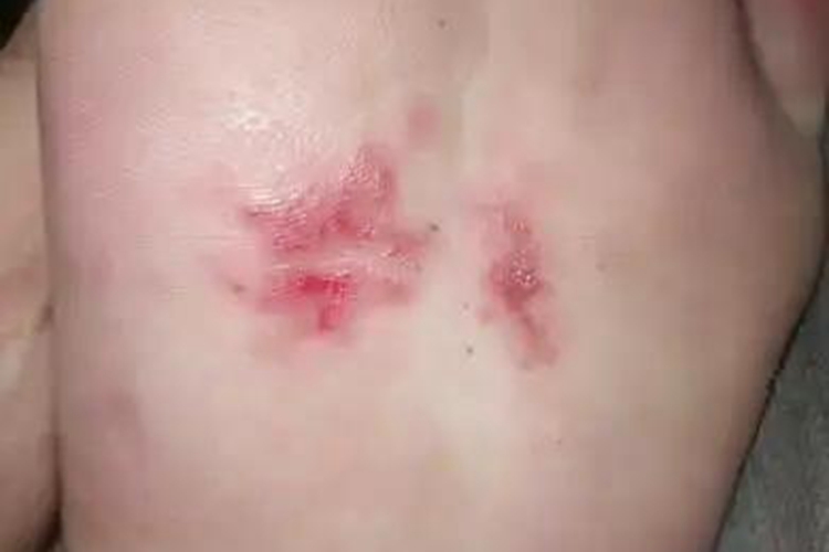 外伤致脚底板皮下出血点图