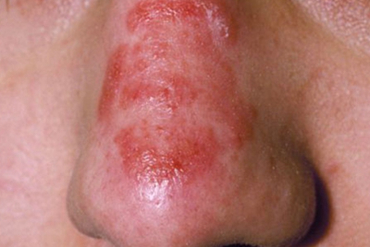 面癣鼻部症状图