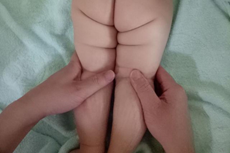 先天性髋关节脱位臀部症状图