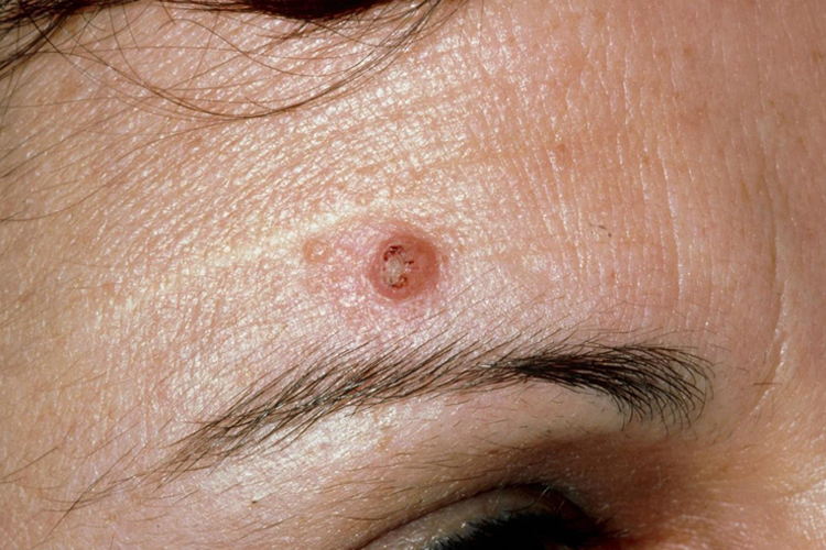 浅表型基底细胞癌图