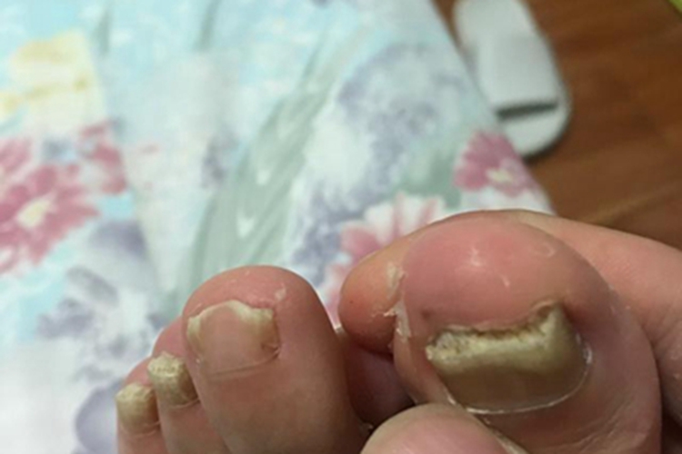 念珠菌性甲真菌病脚趾甲增厚图