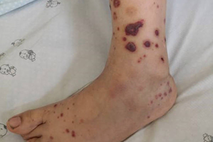 异常蛋白血症紫癜脚踝症状图