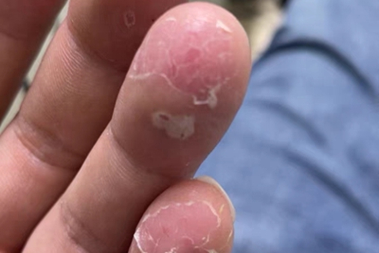 水疱型手癣脱皮图