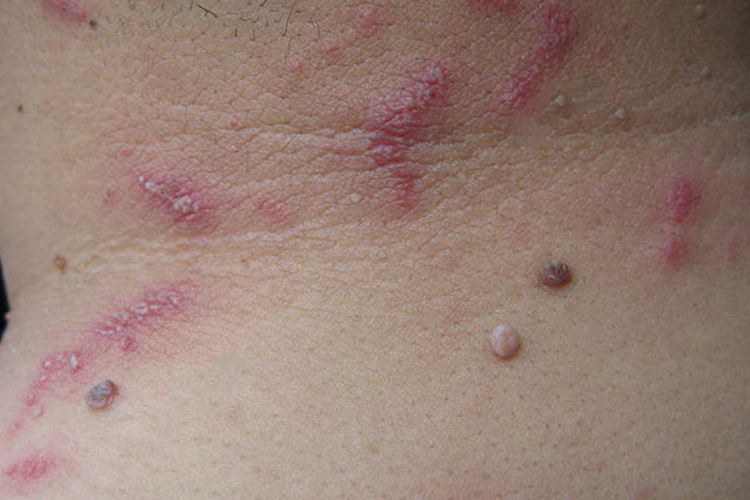 隐翅虫咬人后初期图