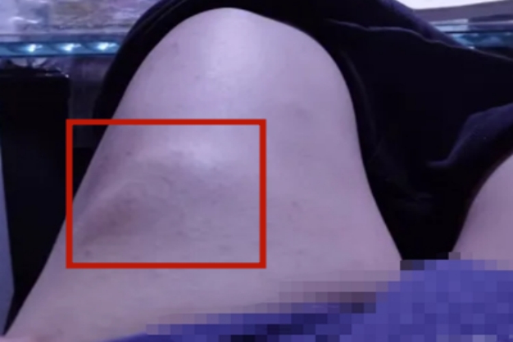 脂肪瘤大腿上长个圆形结节图 脂肪瘤大腿上长个圆形结节图