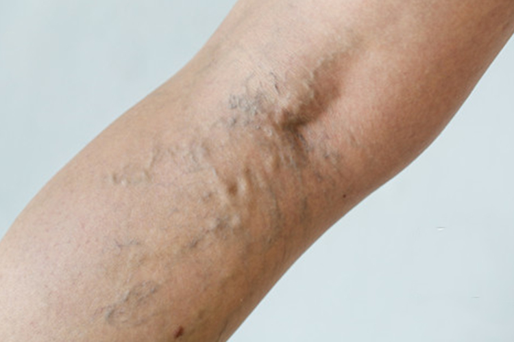 血栓闭塞性脉管炎图