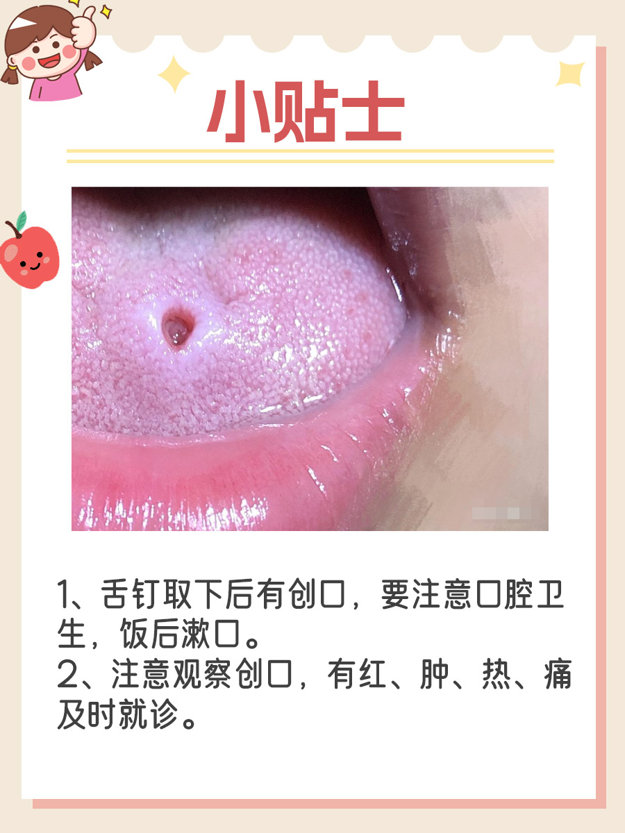 舌钉取下来，多久才能愈合呢？我来为大家揭晓吧