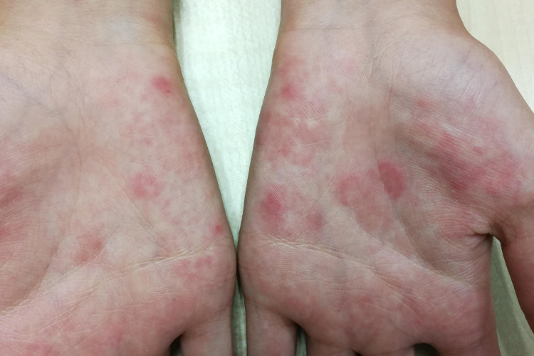 红斑狼疮手掌红色斑块图