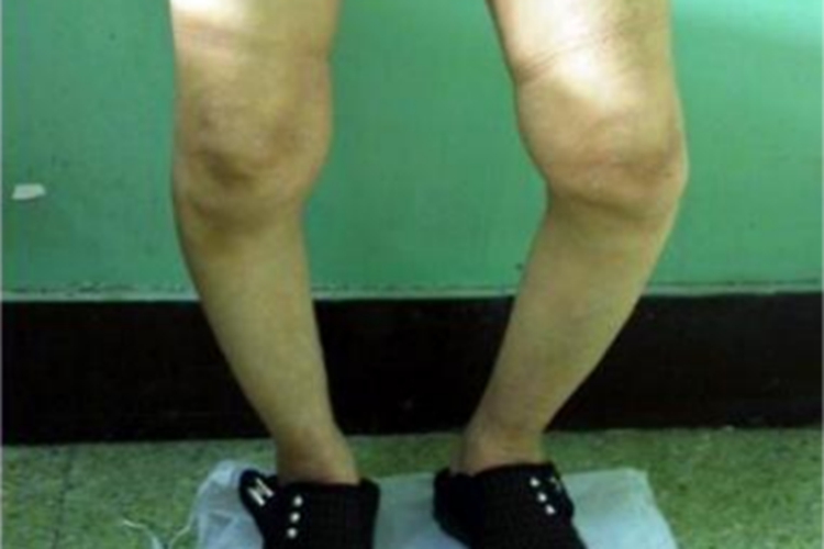 膝内翻严重O型腿图 膝内翻严重O型腿图