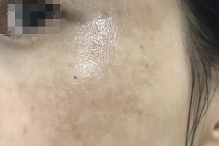 家族性进行性色素沉着症症状图