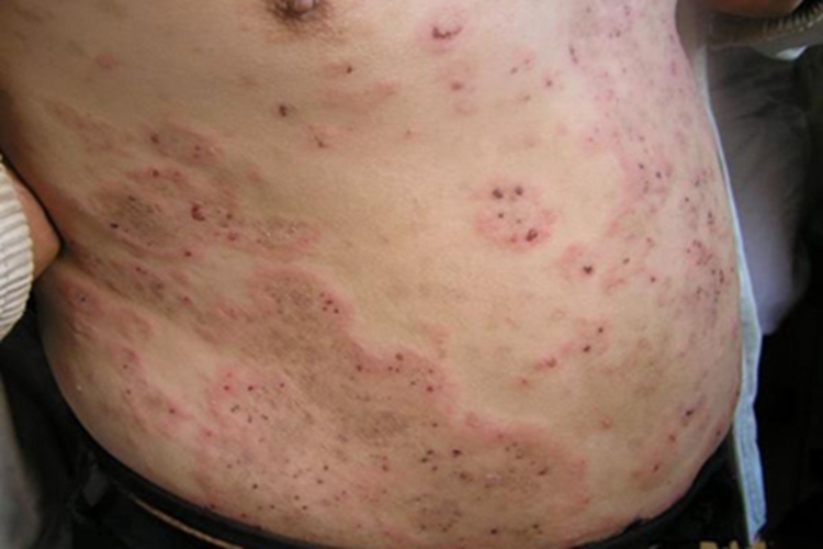 疱疹样皮炎腹部症状图 疱疹样皮炎腹部症状图