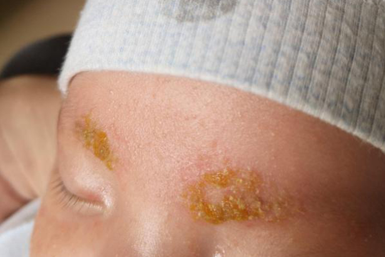 干燥,脂溢性,其中渗出型和脂溢性婴儿湿疹都可引起满月宝宝眉毛上有黄