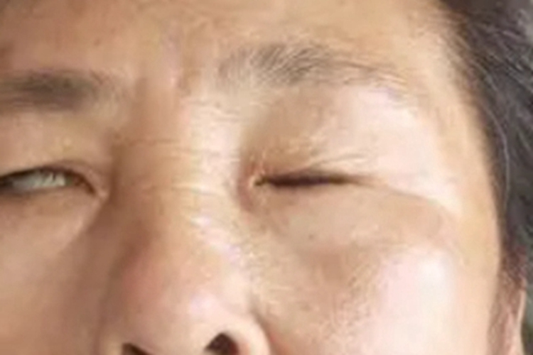 黏液表皮样癌变形图