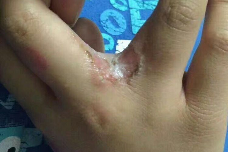 湿疹手指缝中间溃烂图