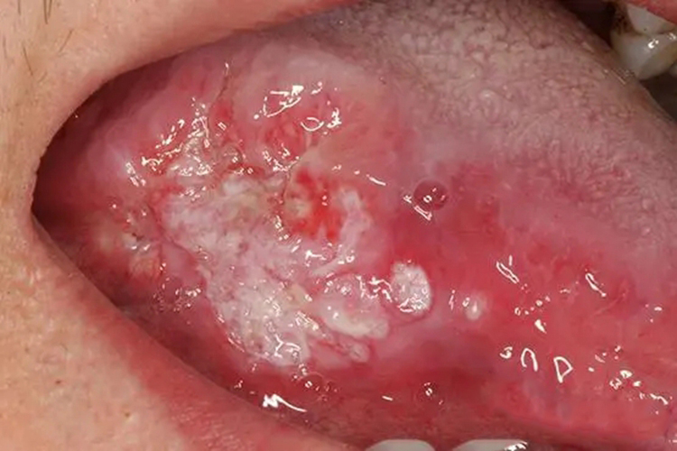 口腔黏膜白斑图