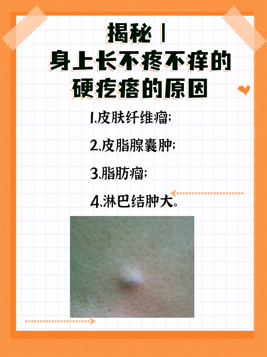 揭秘:身上长不疼不痒的硬疙瘩的原因