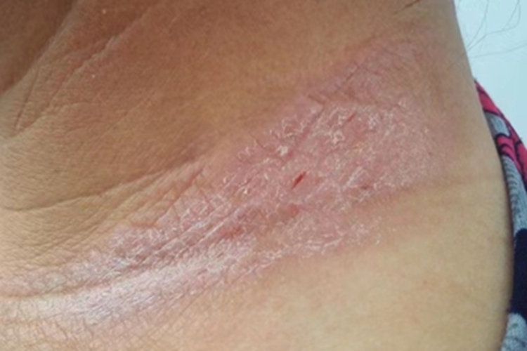 局限性神经性皮炎侧颈脱皮图