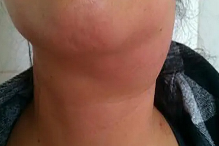 鼻咽癌颈部淋巴结肿大图 鼻咽癌颈部淋巴结肿大图