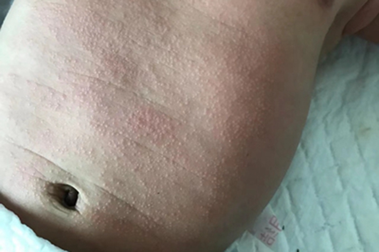 红痱丘疹图 红痱丘疹图