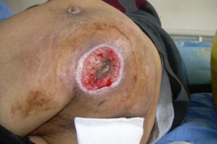 压疮臀部大坑图 压疮臀部大坑图