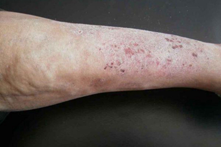 淤积性皮炎小腿血痂图