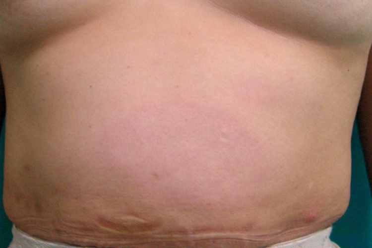 结核样型麻风图