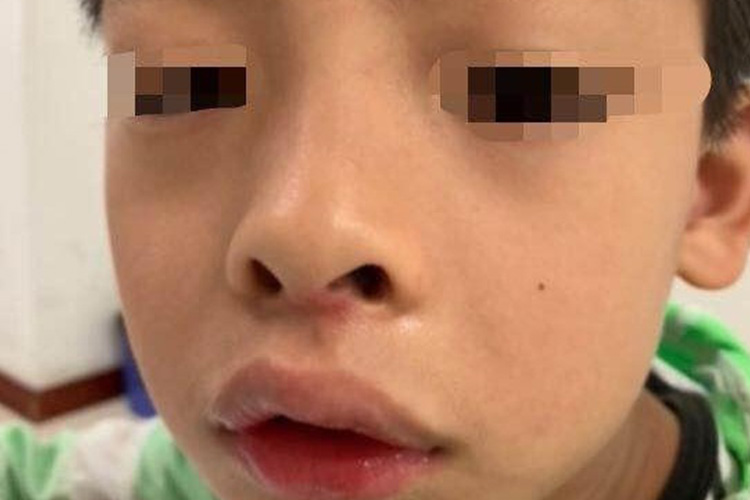 儿童整体的腺样体面容图