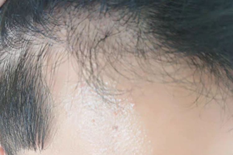 雄激素性脱发前额侧边脱发图