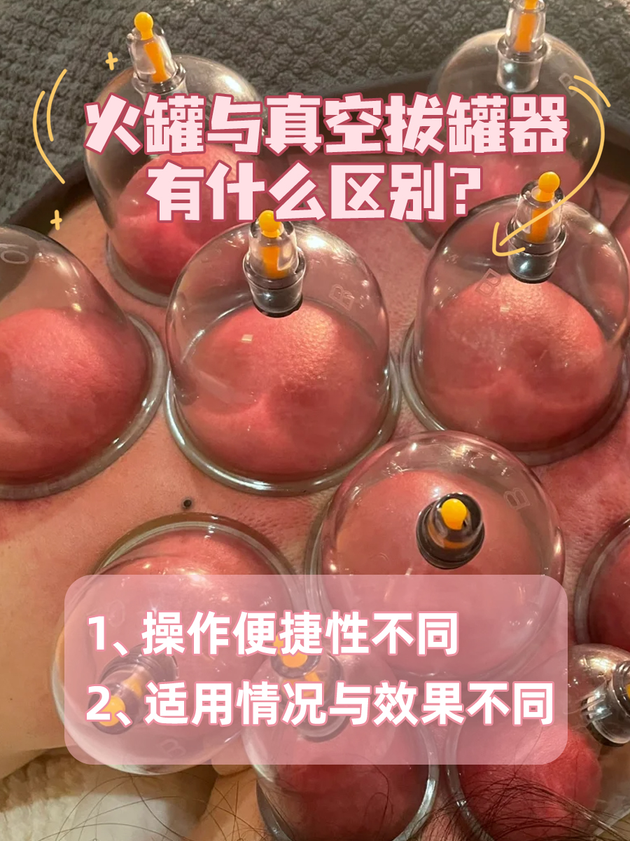 火罐与真空拔罐器有什么区别?医生一文讲清