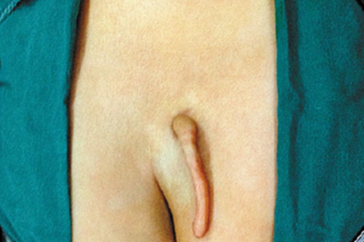 先天性脊柱裂畸形图