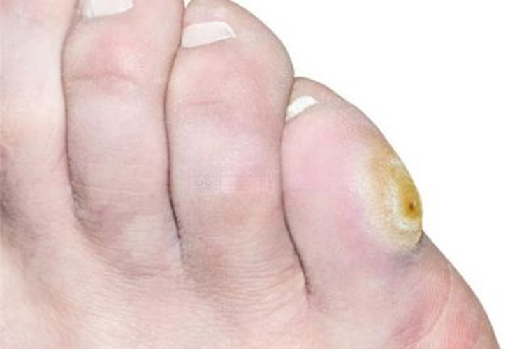 硬鸡眼脚趾圆疙瘩图 硬鸡眼脚趾圆疙瘩图