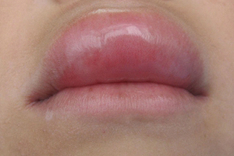 获得性血管性水肿上嘴唇肿亮图