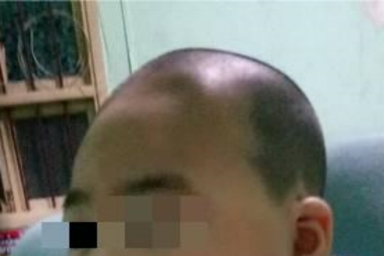 小头畸形头比正常人小图 小头畸形头比正常人小图