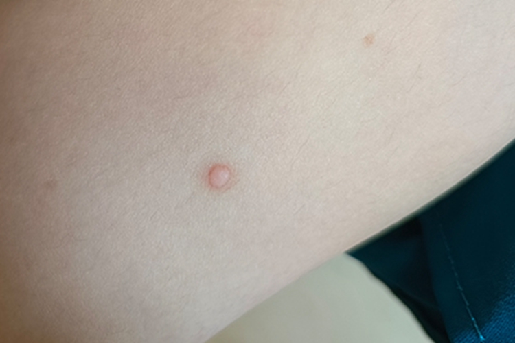 寻常疣大腿侧面浅红色丘疹图