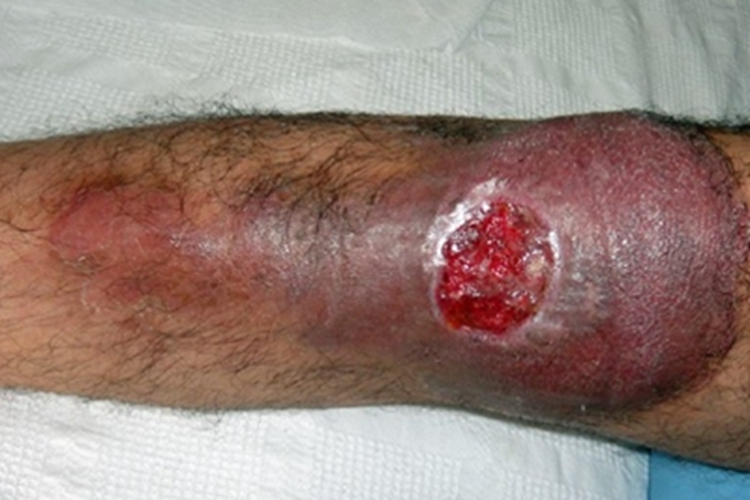 海鱼分枝杆菌感染膝盖结节图 海鱼分枝杆菌感染膝盖结节图