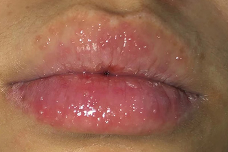 急性光化性唇炎水疱图 急性光化性唇炎水疱图