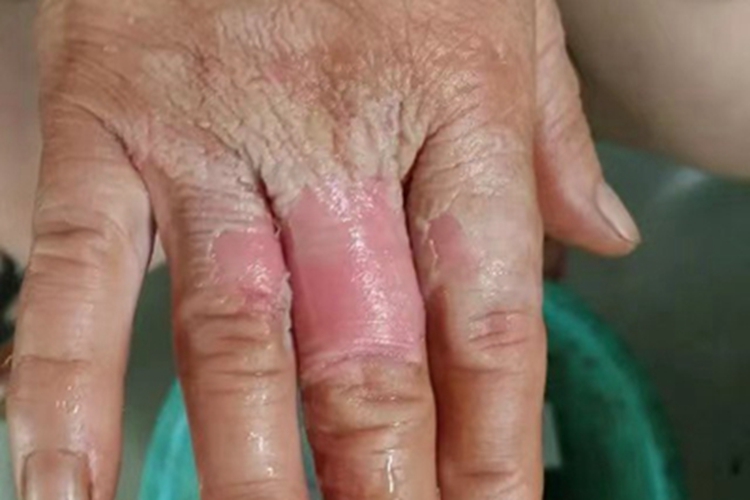 二度烫伤手指红斑图