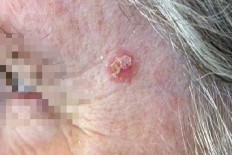 老年性角化病颞部症状图