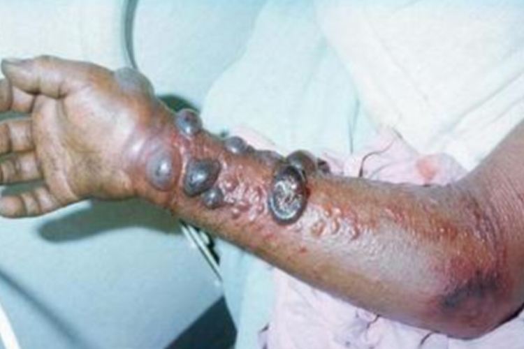 埃博拉病毒患者图