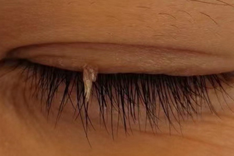 丝状疣眼睑症状图