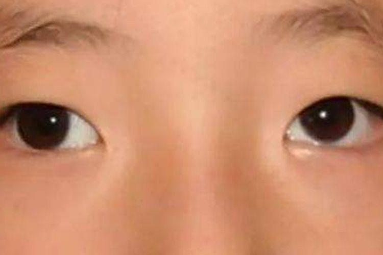 小孩子有点垂直斜视图 小孩子有点垂直斜视图