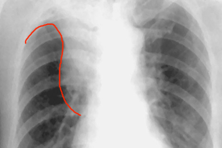 肺鳞癌Ⅲ期X线图