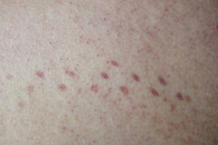 紫癜后背紫色斑点图