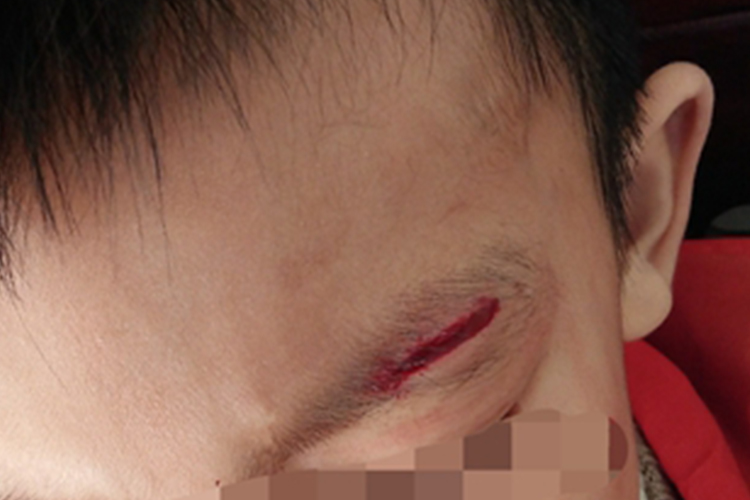 撞伤皮肤肿图 撞伤皮肤肿图