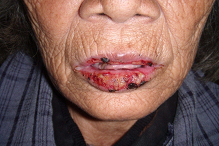 急性光线性唇炎嘴唇糜烂图