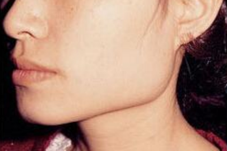 下颌骨磨骨手术前图