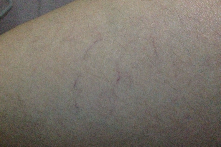 血栓性浅静脉炎图