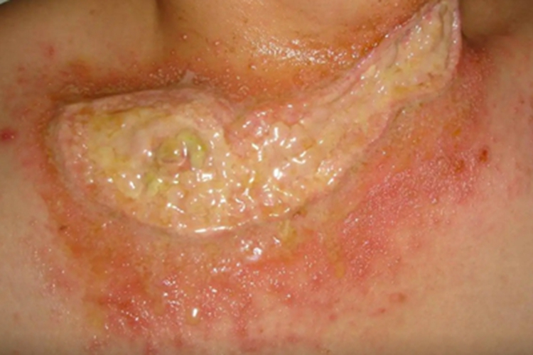 猩红热胸部丘疹图